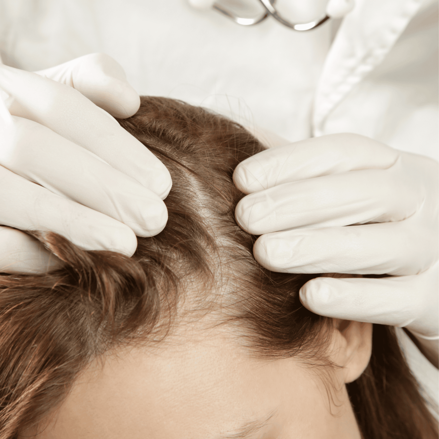 Hair Loss | تساقط الشعر